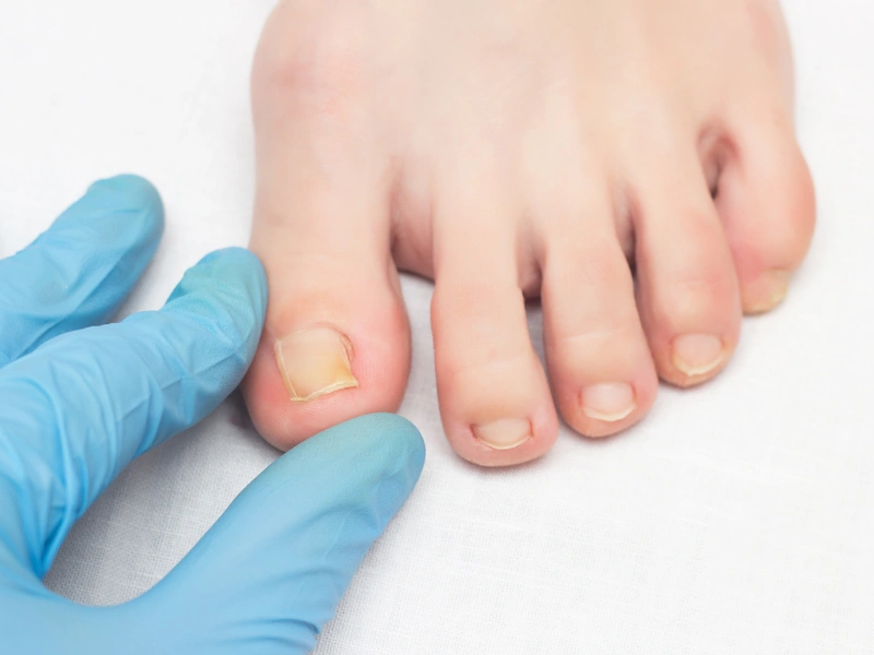 What is Toenail Fungus Treatment