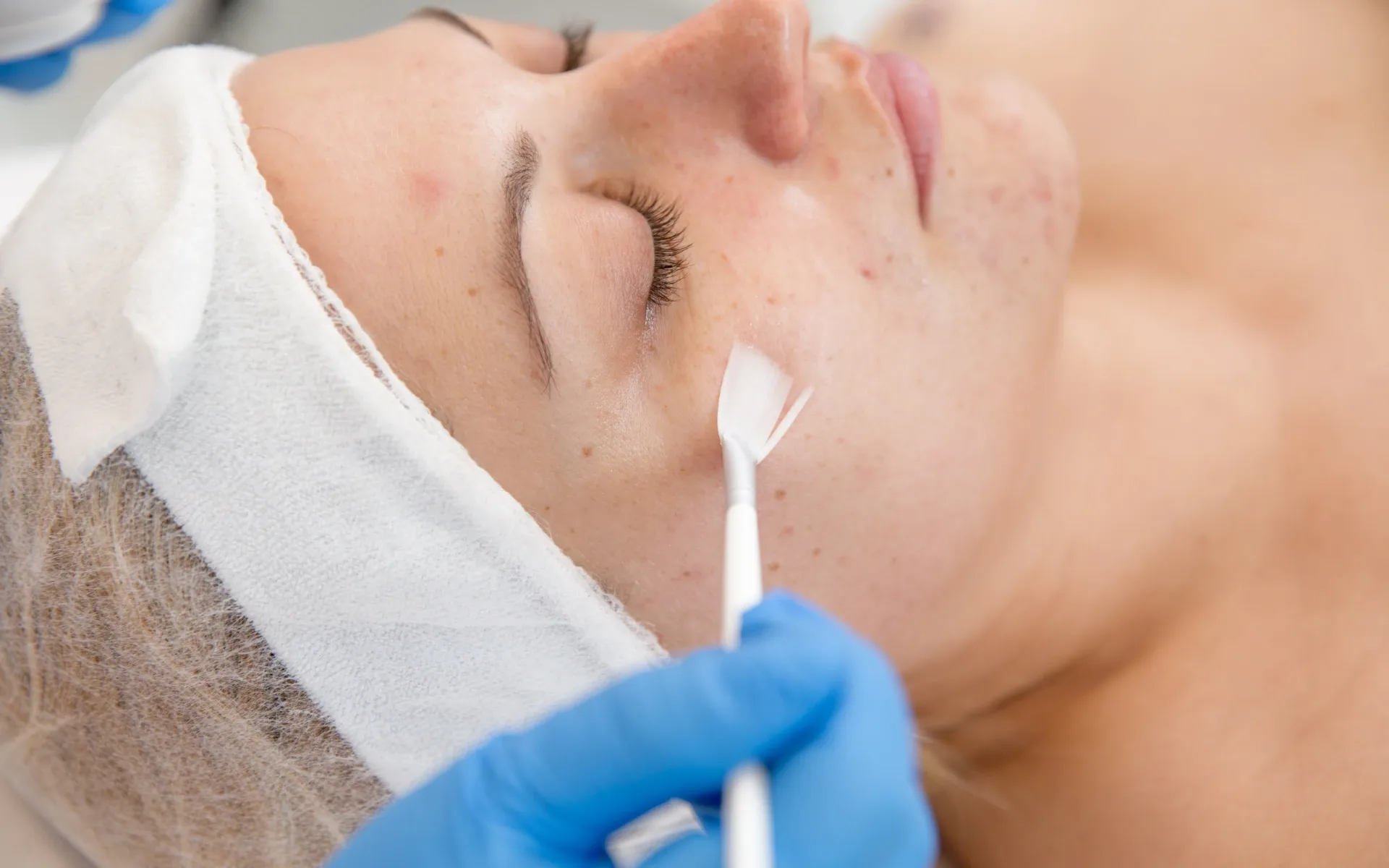 chemical peels in houston tx