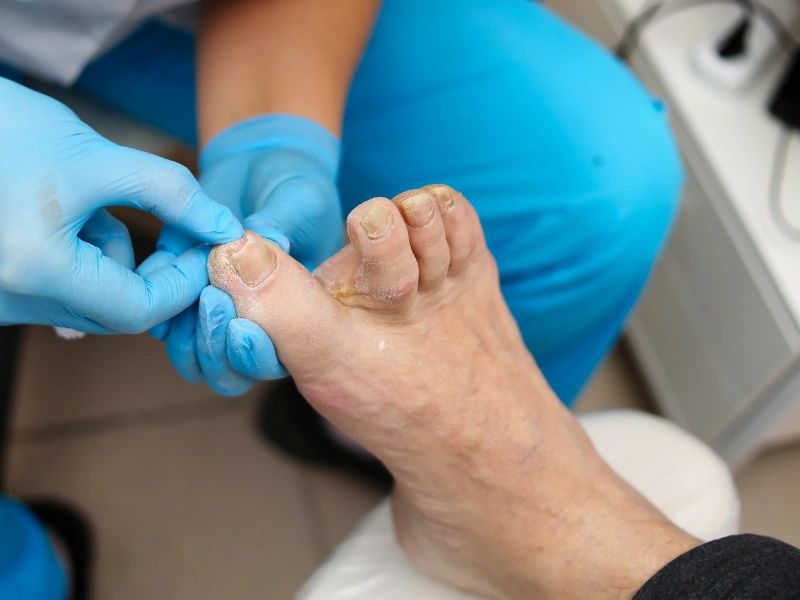 ideal candidates for toenail fungus treatment
