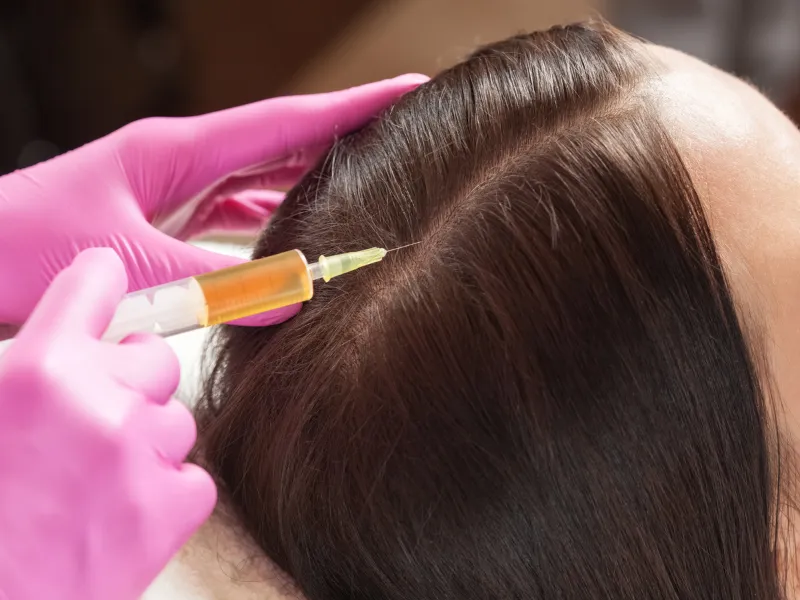 prp microneedling for hair
