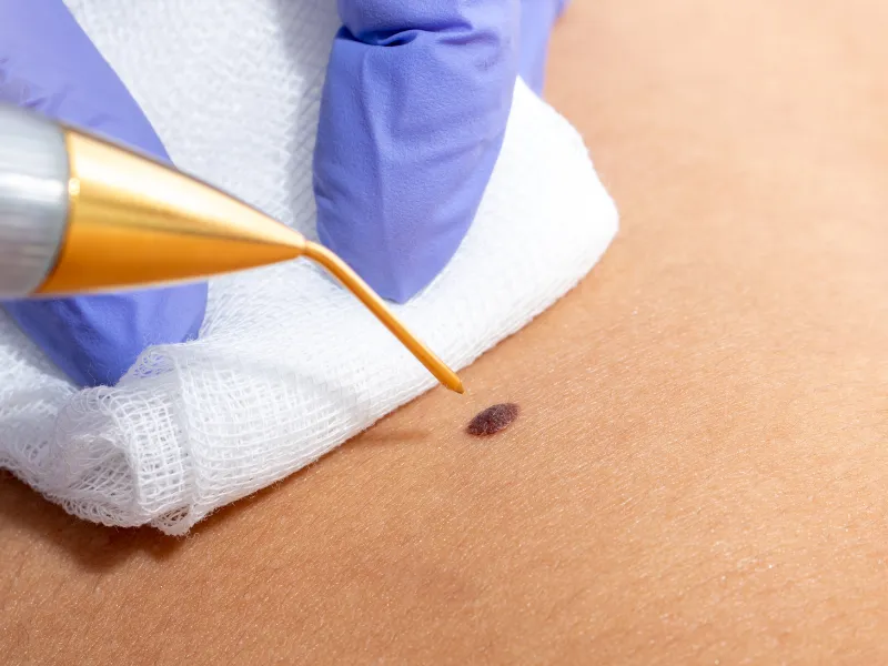 skin tag removal
