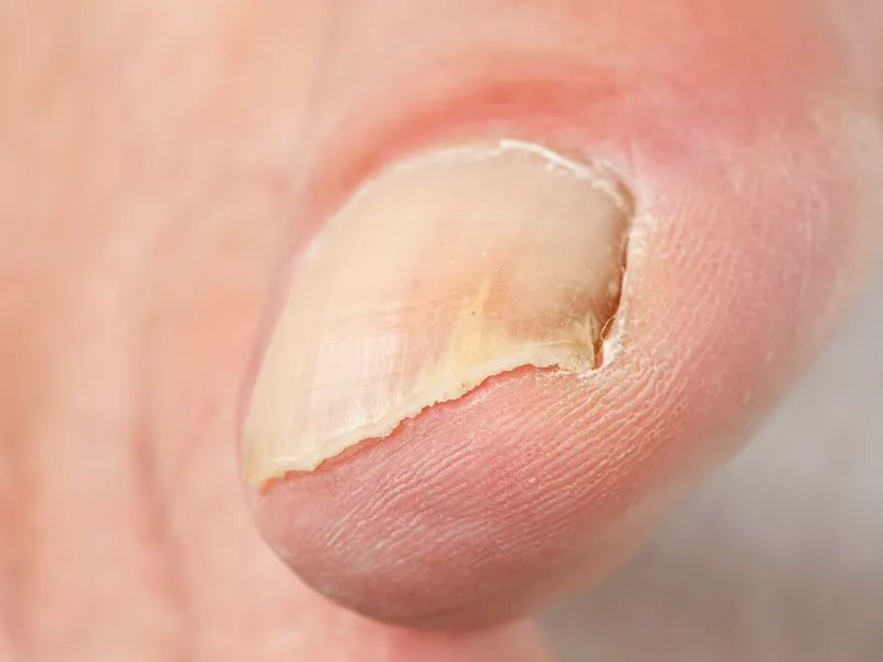 toenail fungus treatment