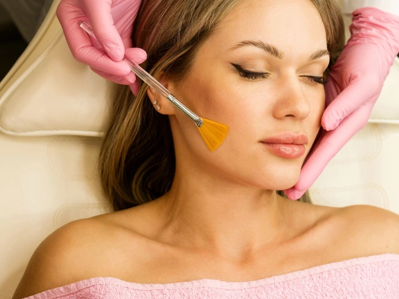 what is a chemical peel