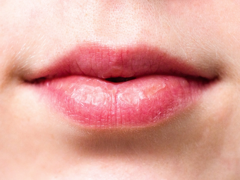 what is hydrafacial lip perk