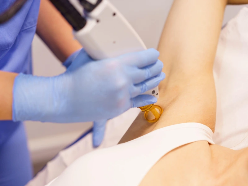 initial laser hair removal
