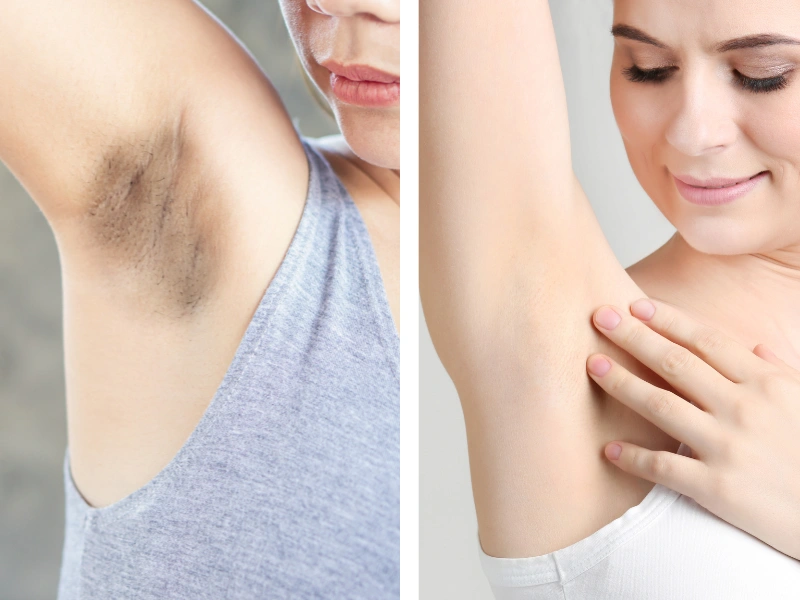 Underarm Laser Hair Removal Before and After