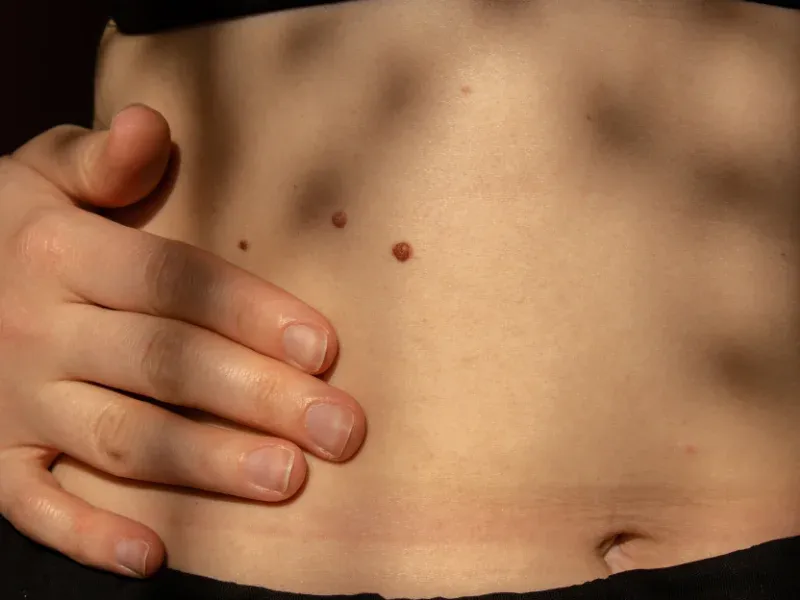best skin tags removal