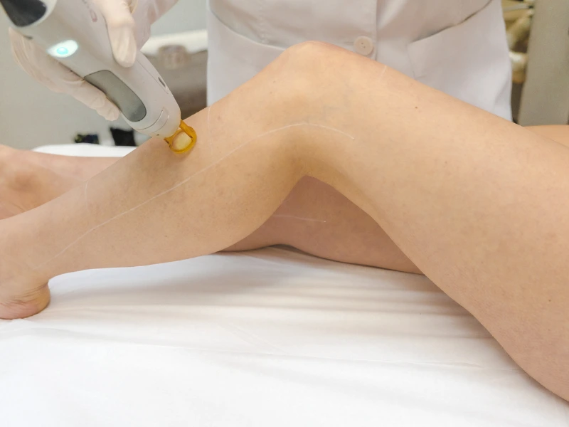full body laser hair removal package pricing