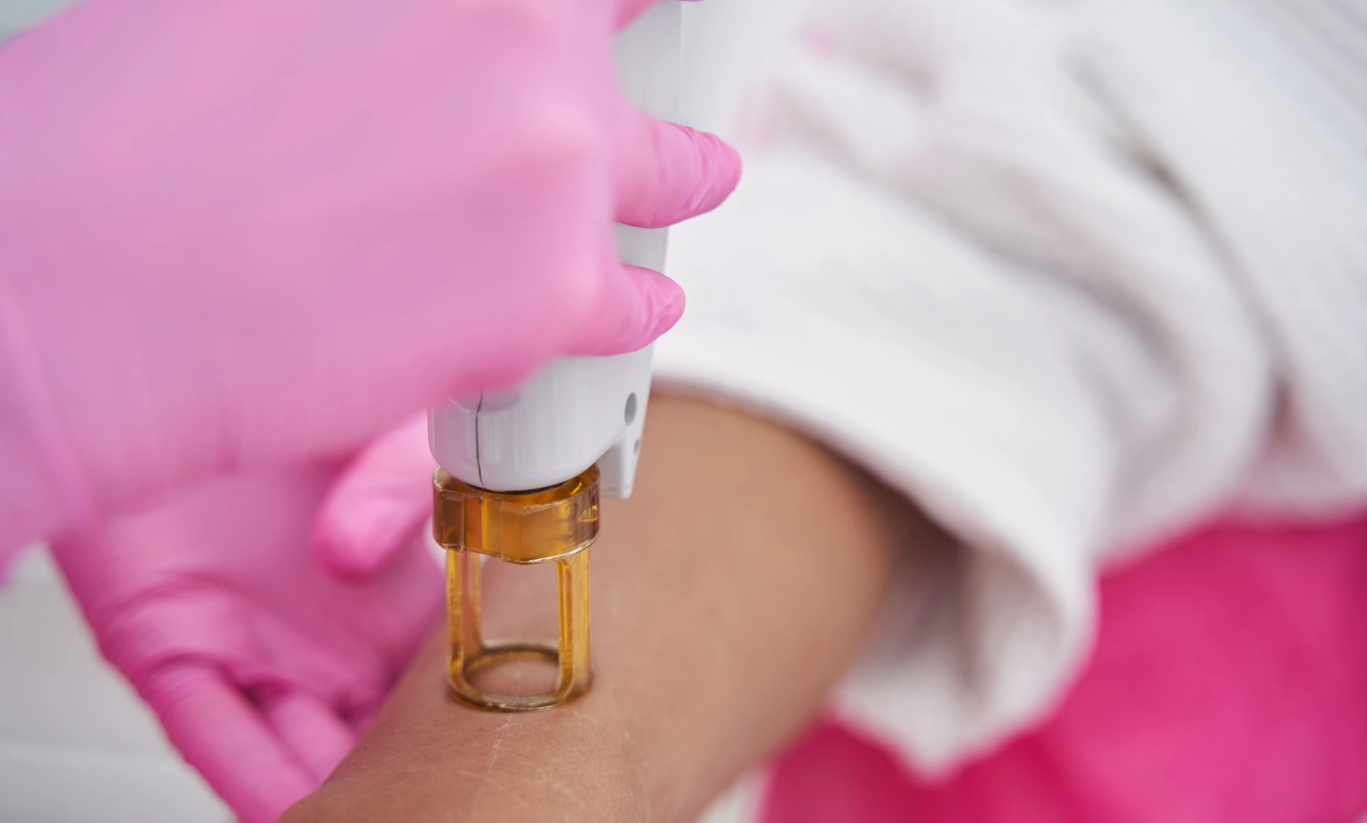 how to prep for laser hair removal