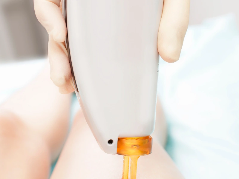 laser hair pregnancy