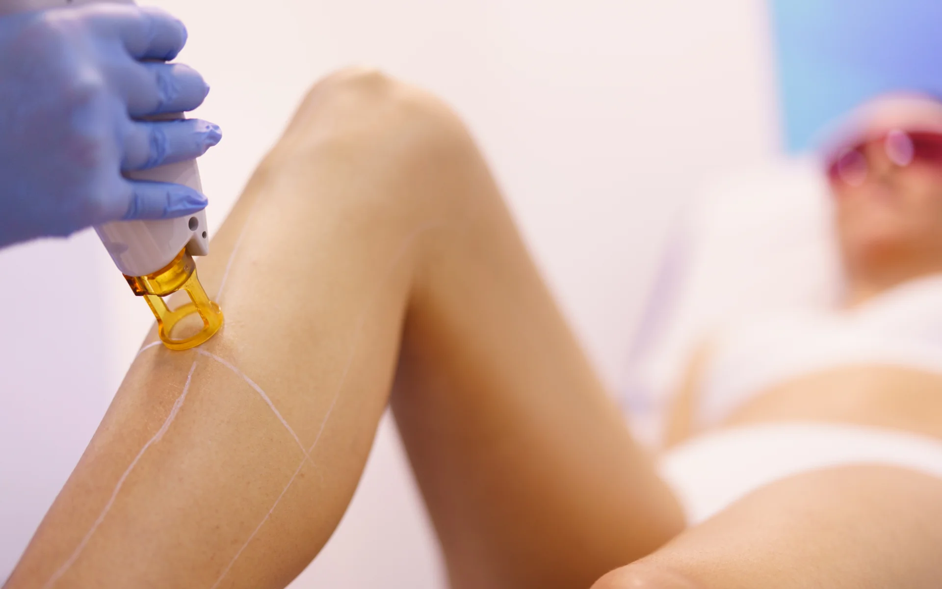 laser hair removal legs