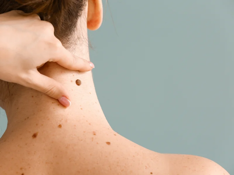 skin tag removal before and after