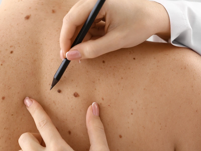 skin tag removal benefits