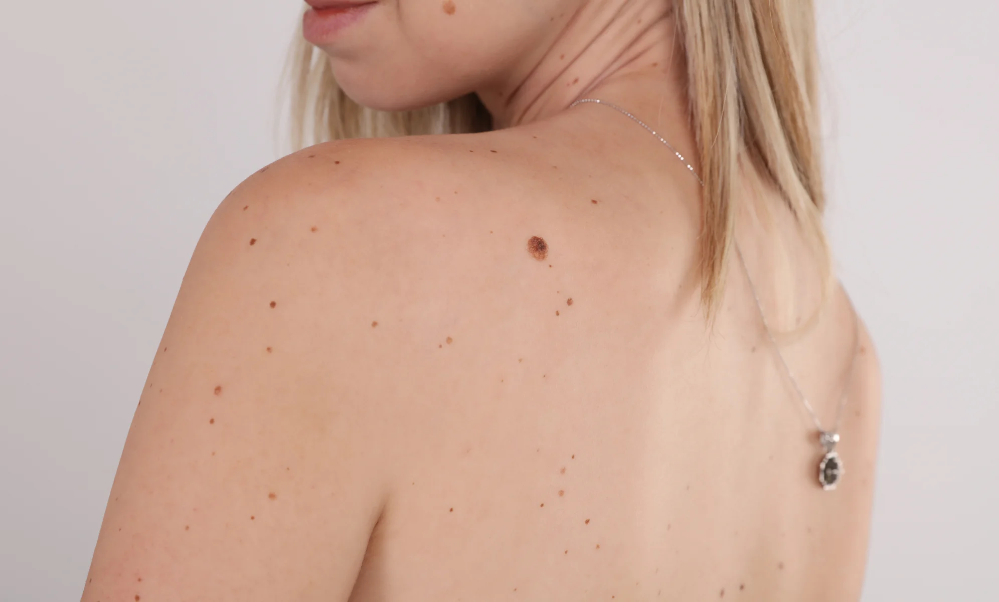 skin tag removal healing time