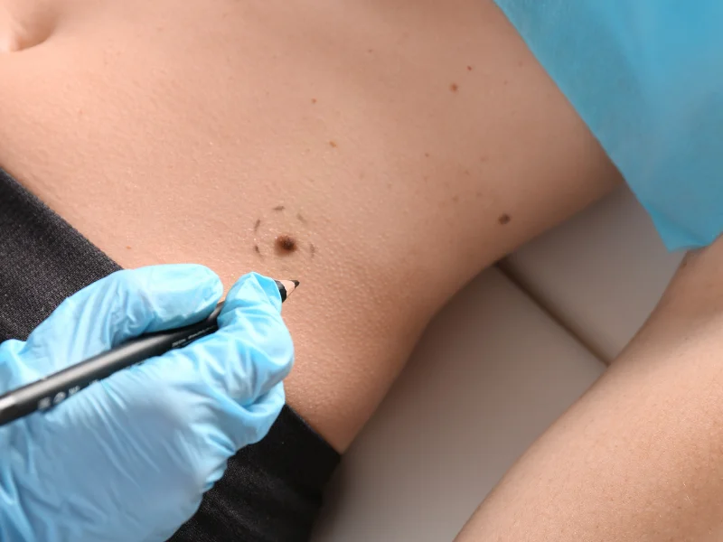 skin tag removal post care