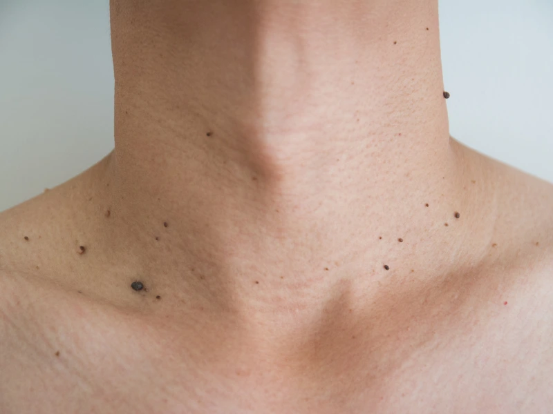 what is skin tag removal