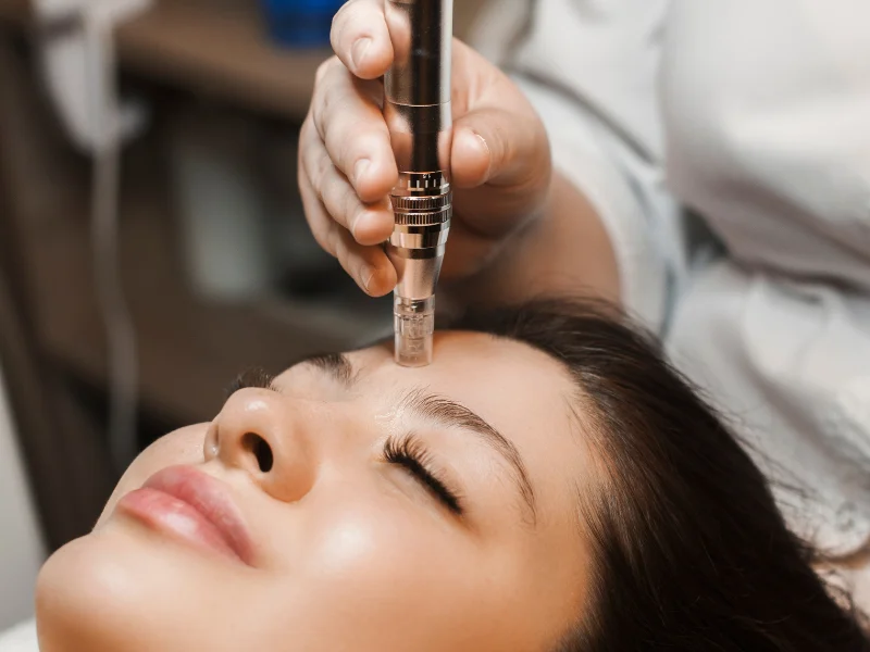 what's microneedling