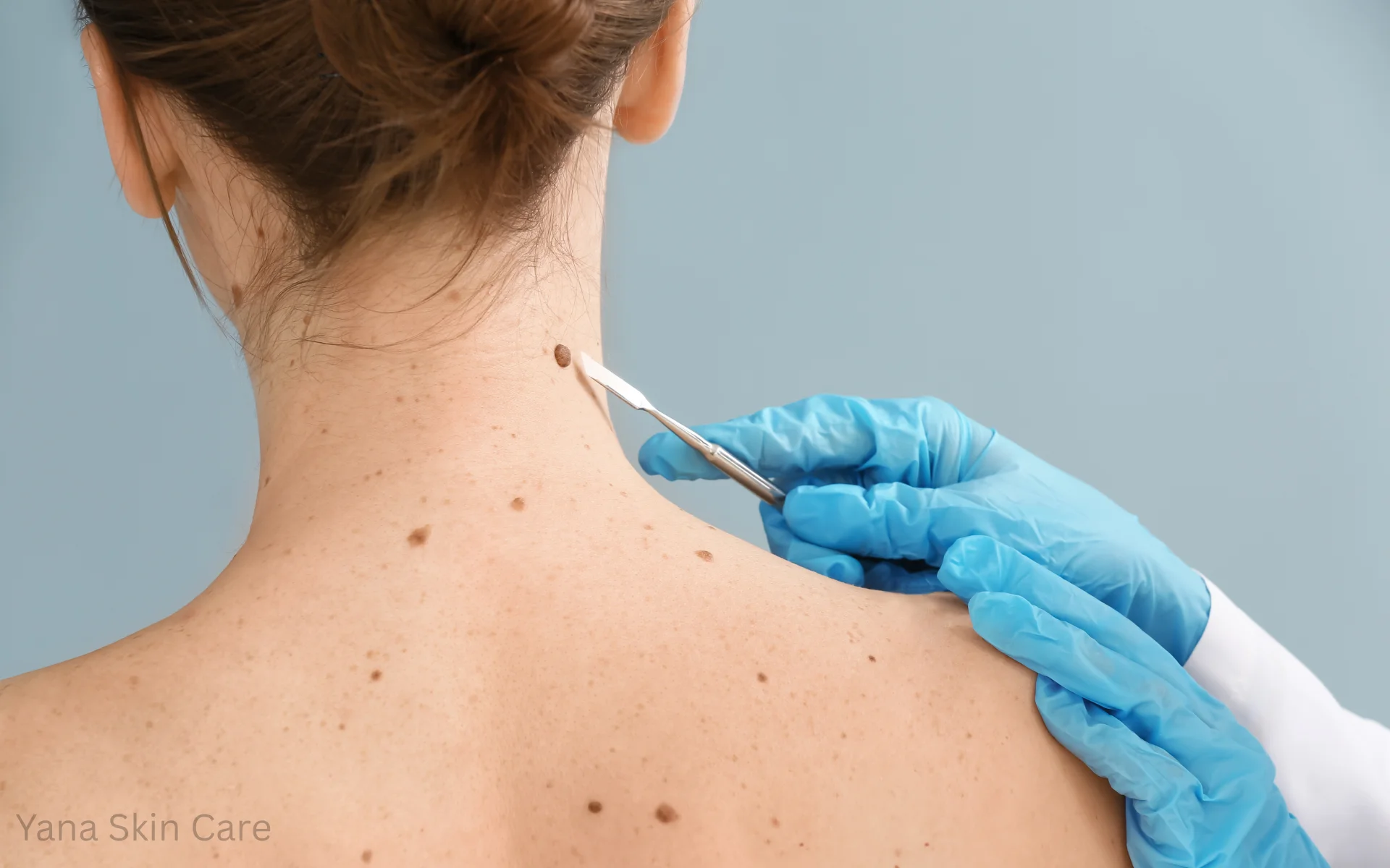 how much does It cost to remove skin tags