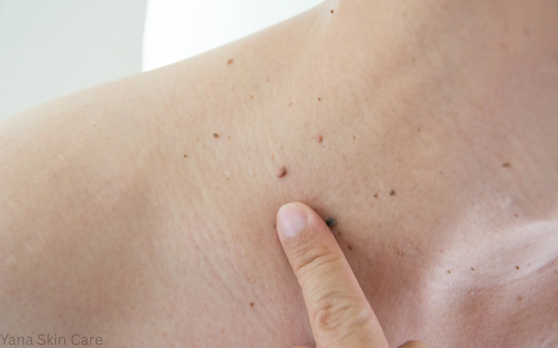 neck skin tag removal in houston tx