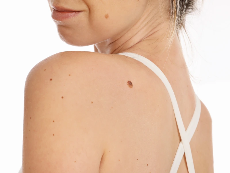 what are facial skin tags