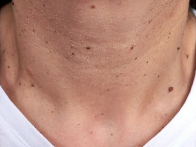 understanding skin tags