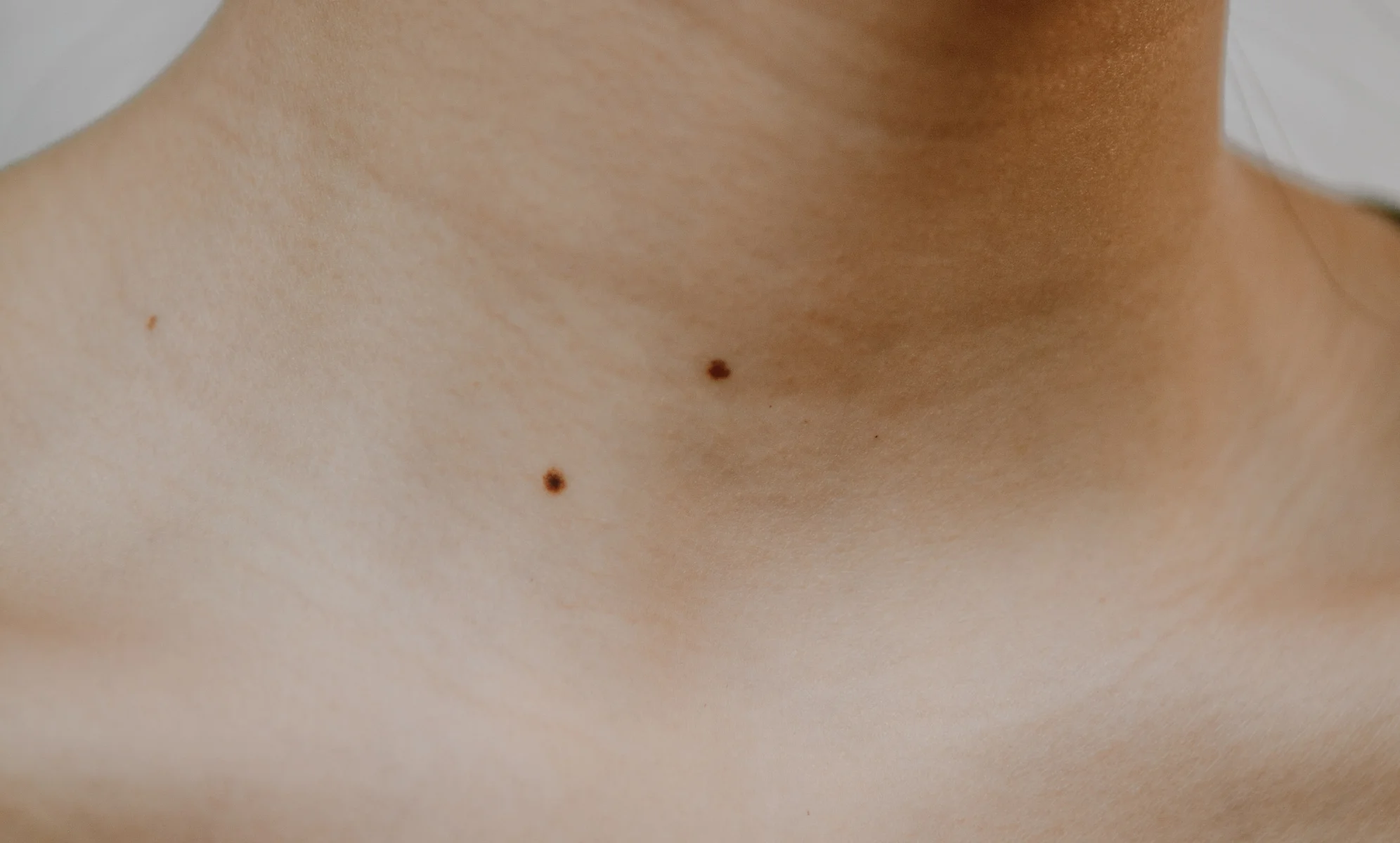 what causes skin tags on neck
