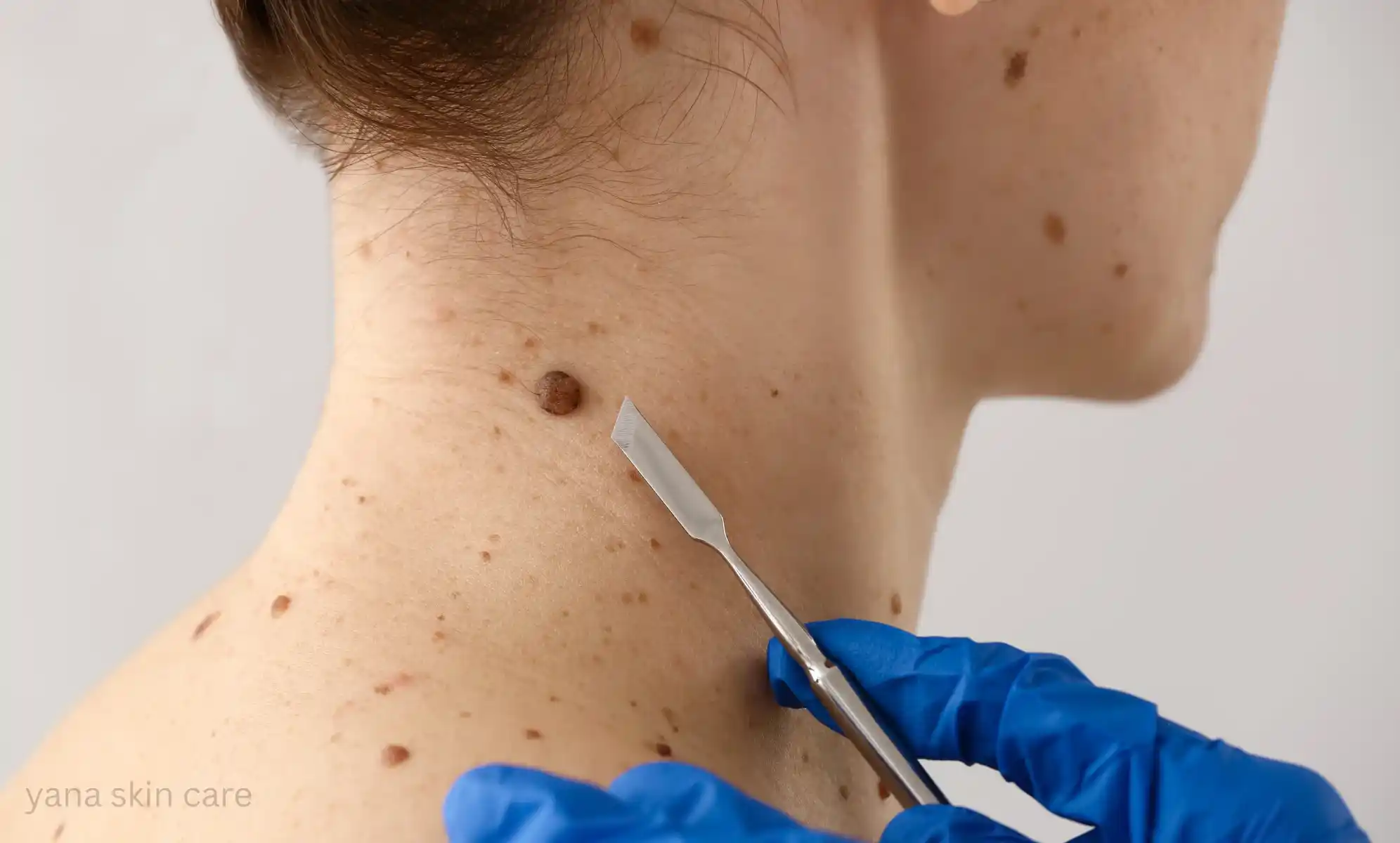 are skin tags cancerous