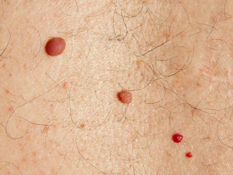 best laser genesis xeo for cherry angioma
