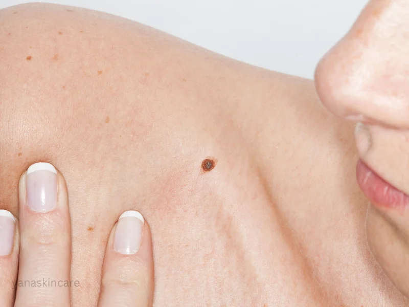 cancer skin tags