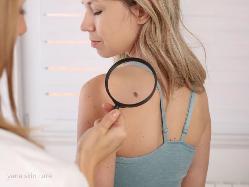 cancerous skin tag