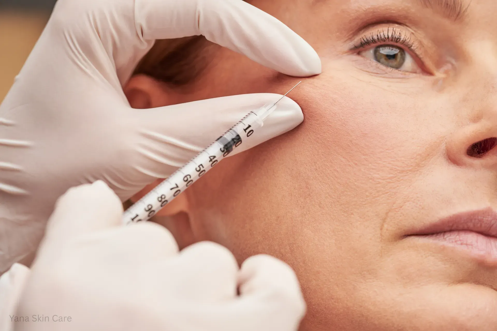 dermal filler for under eye hollows