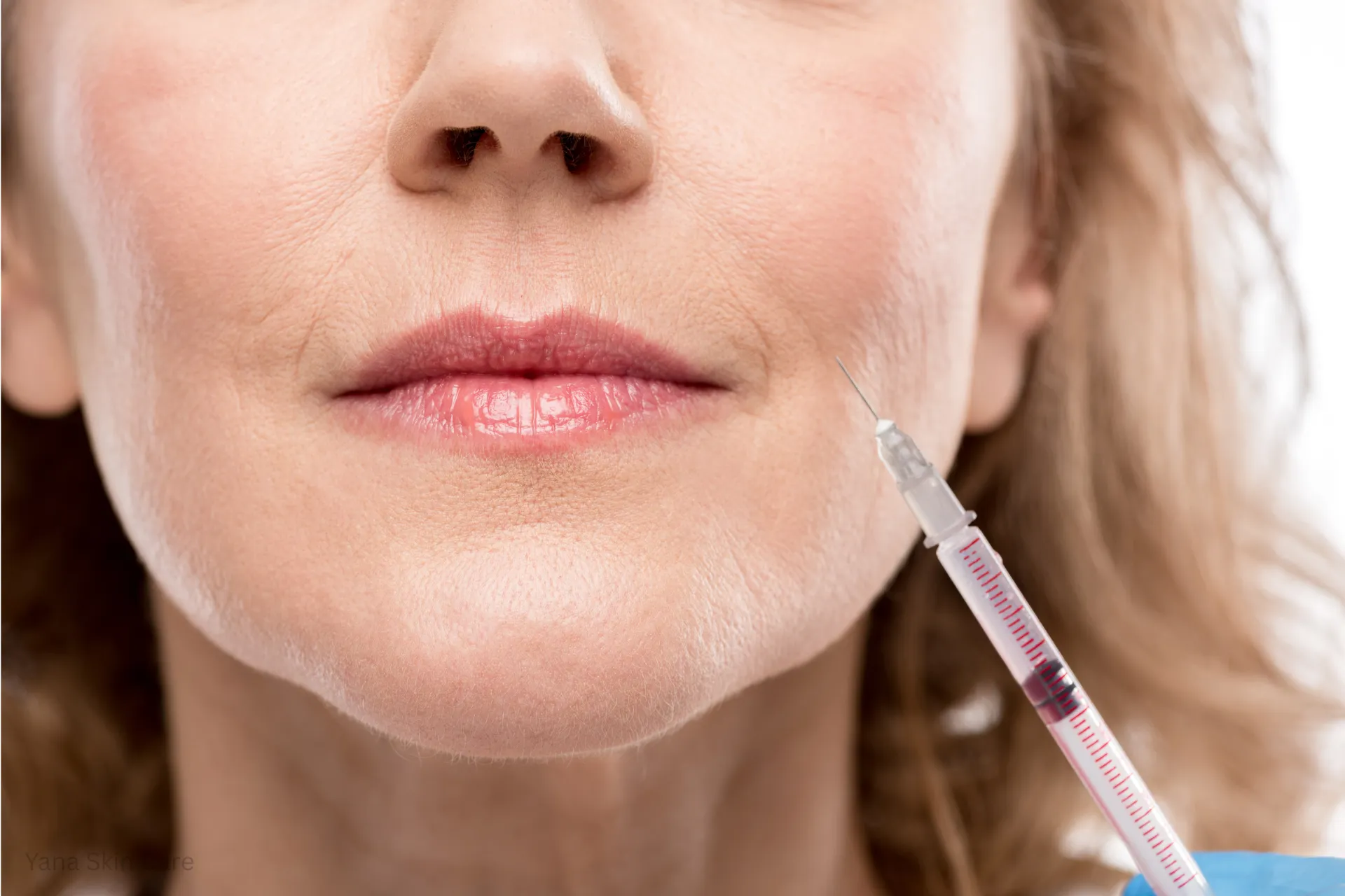 dermal fillers for nasolabial folds