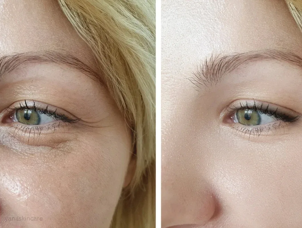 hydrafacial eye perk before and after