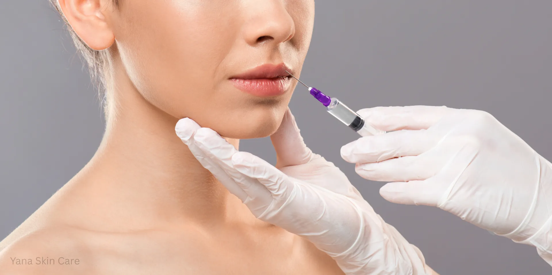 juvederm for marionette lines
