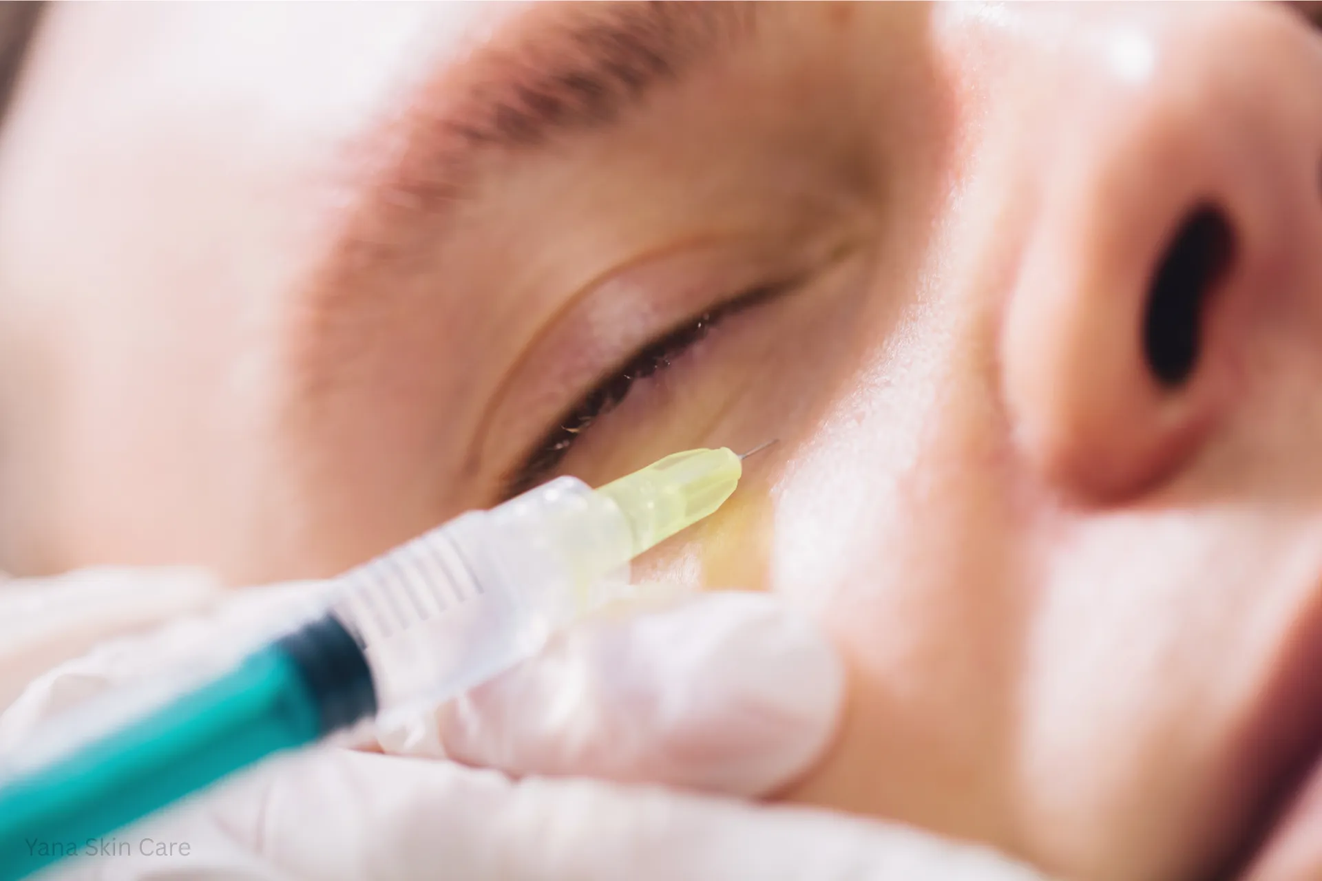 juvederm for under eyes​