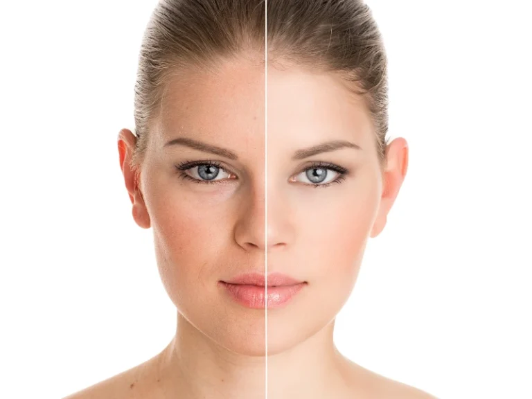 led light therapy face