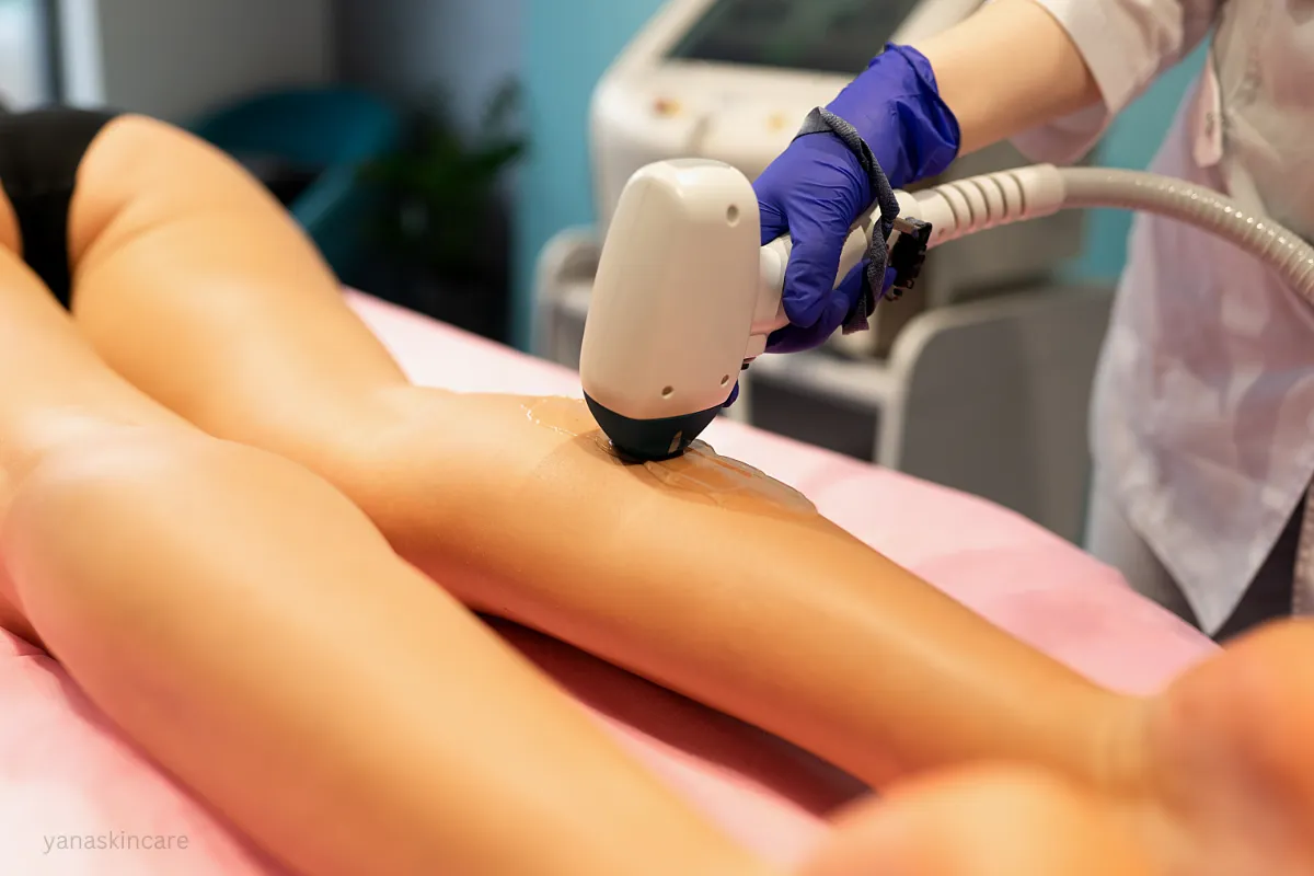 brazilian laser removal procedure