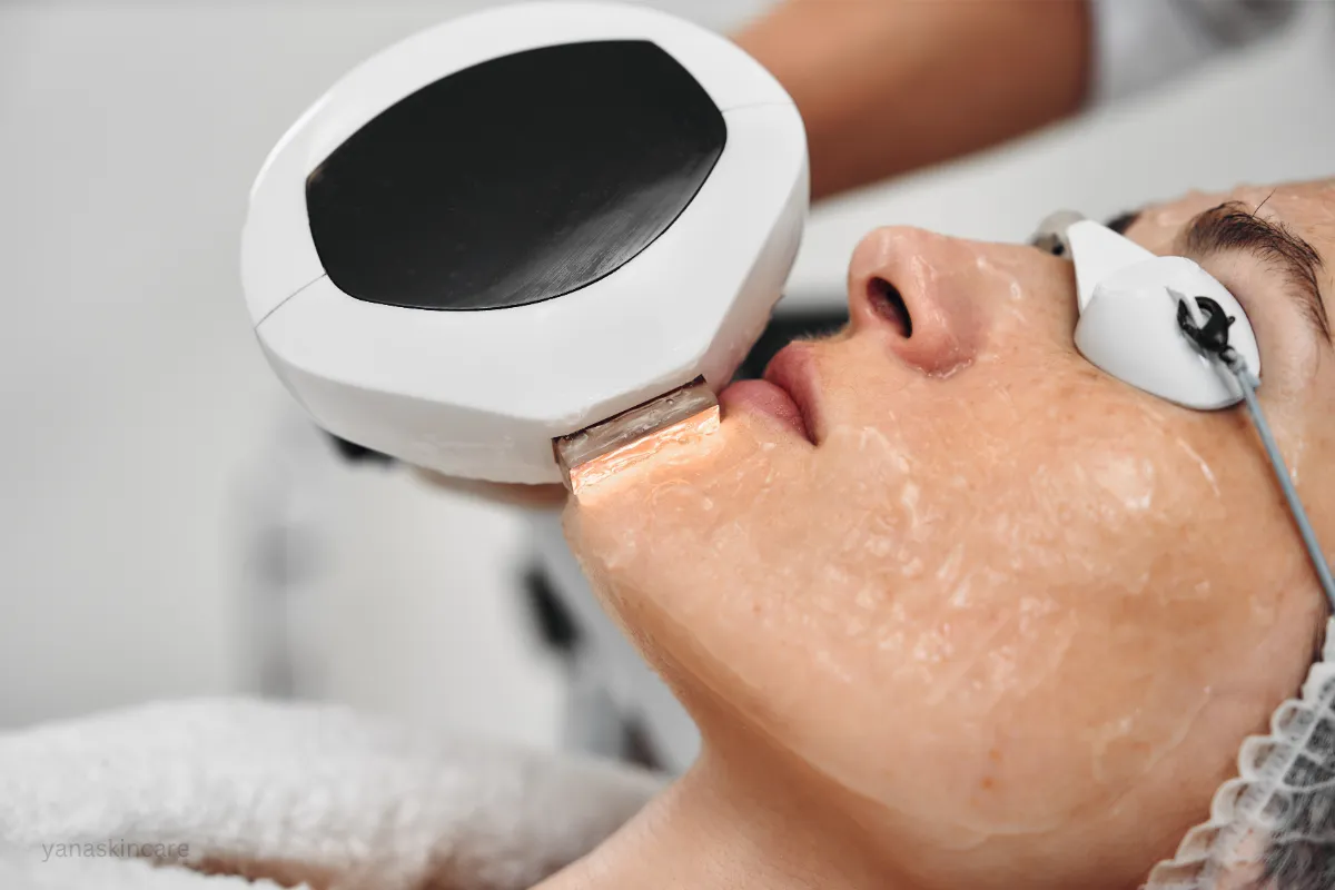 ipl vs professional laser hair removal