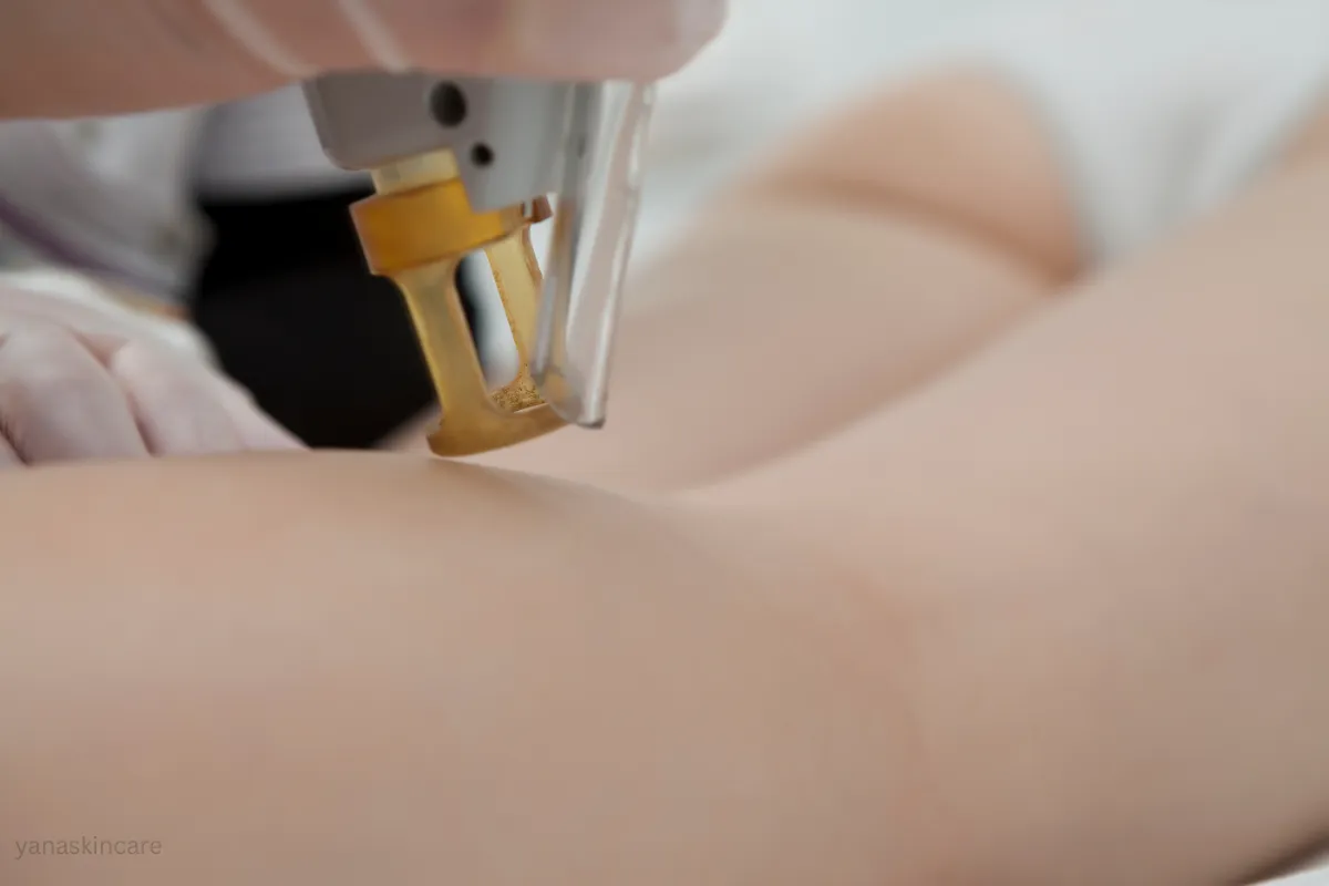 laser hair removal after 6 sessions