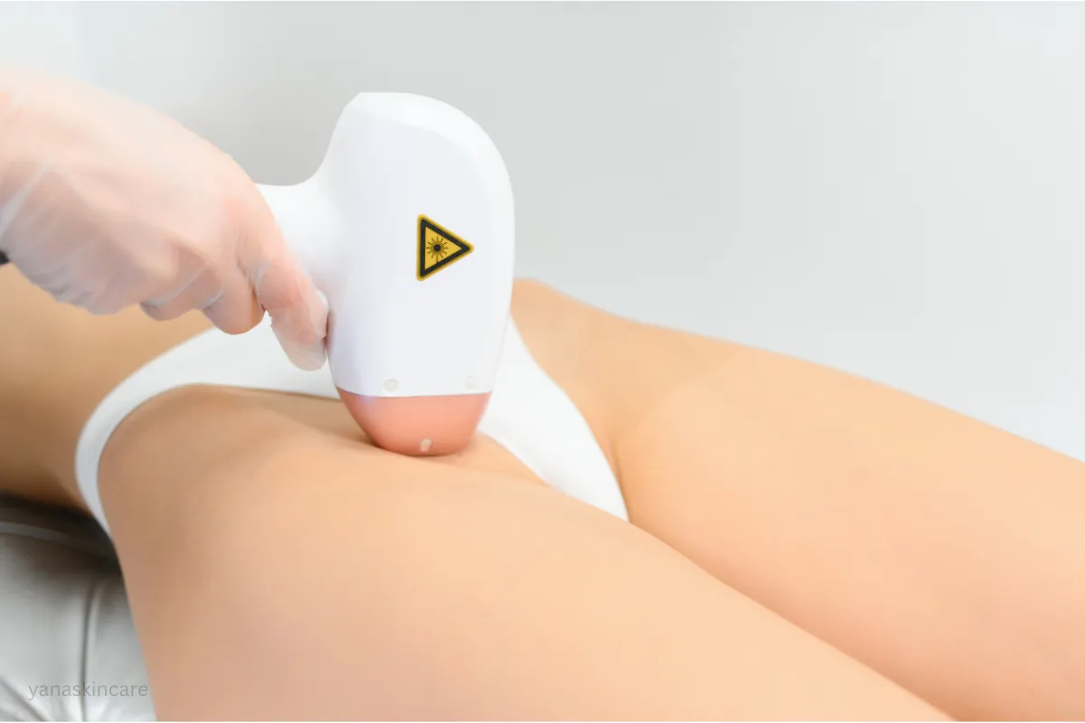 laser hair removal brazilian results