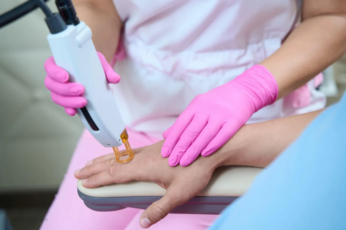 the laser hair removal process