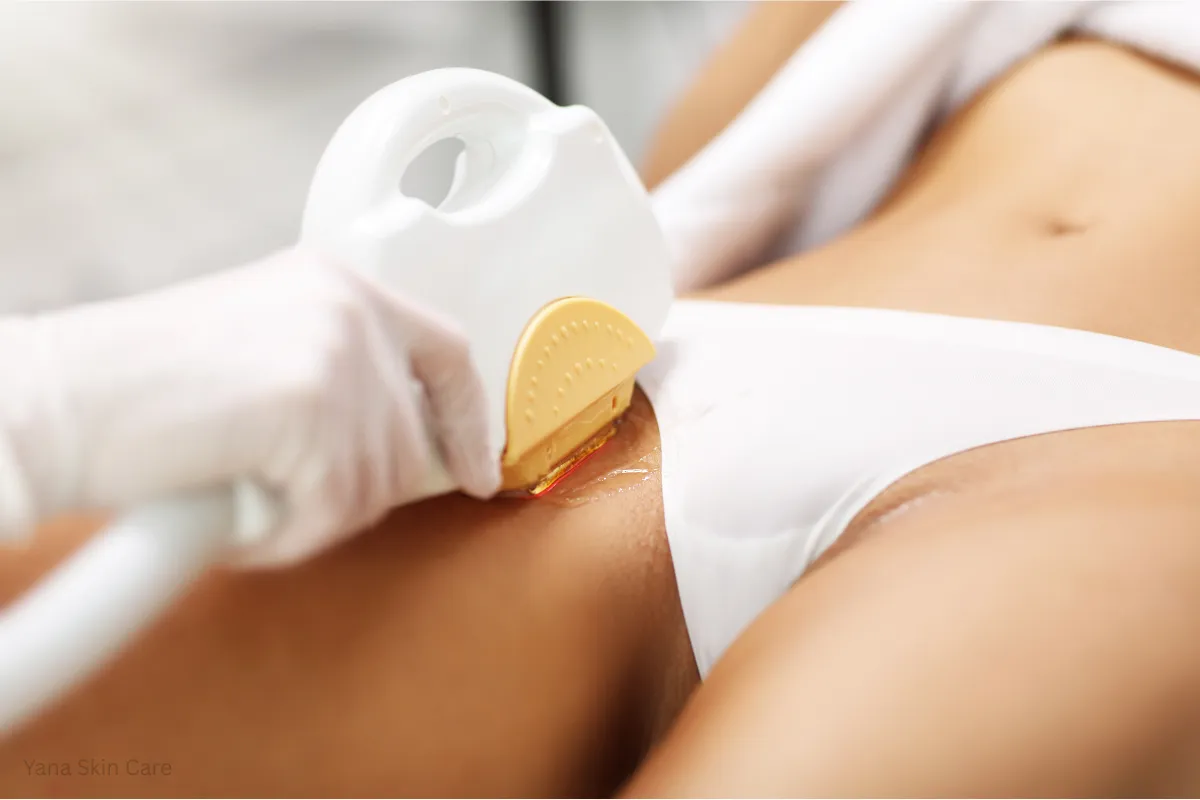 what is a brazilian laser hair removal
