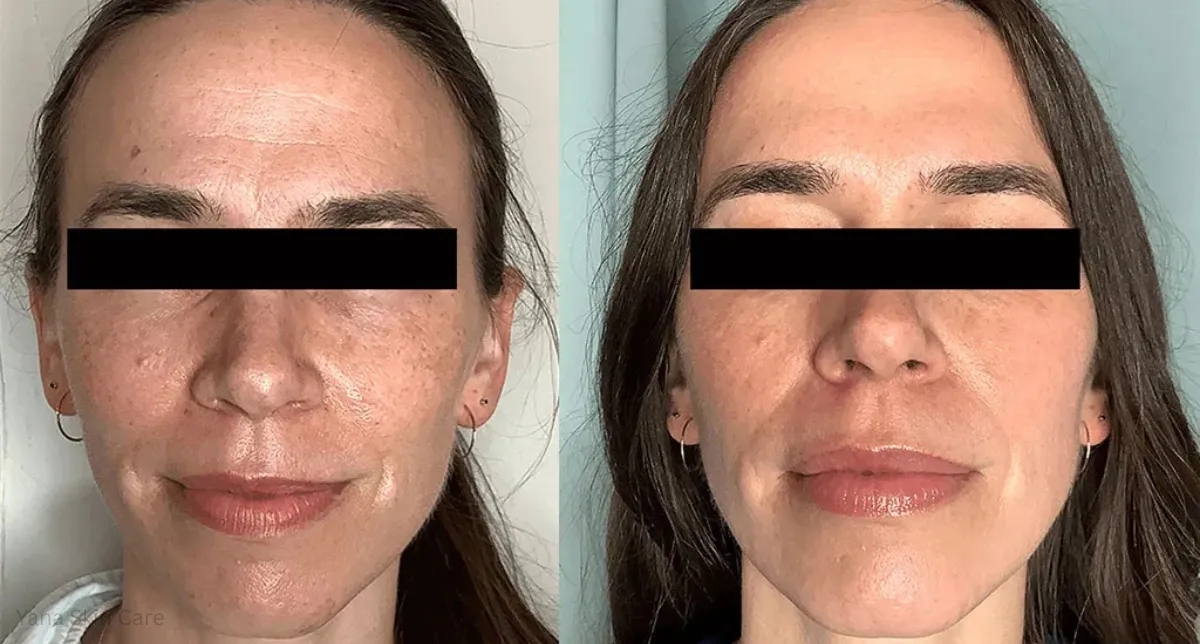 before after laser genesis