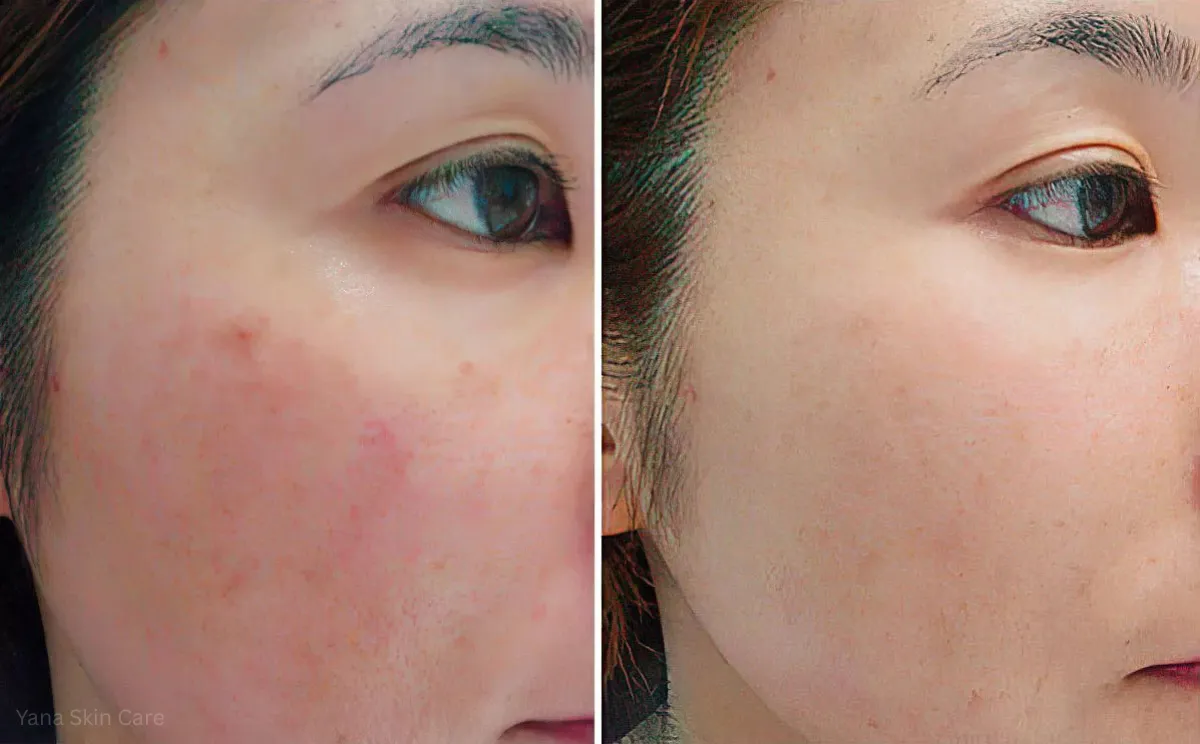 before and after laser genesis