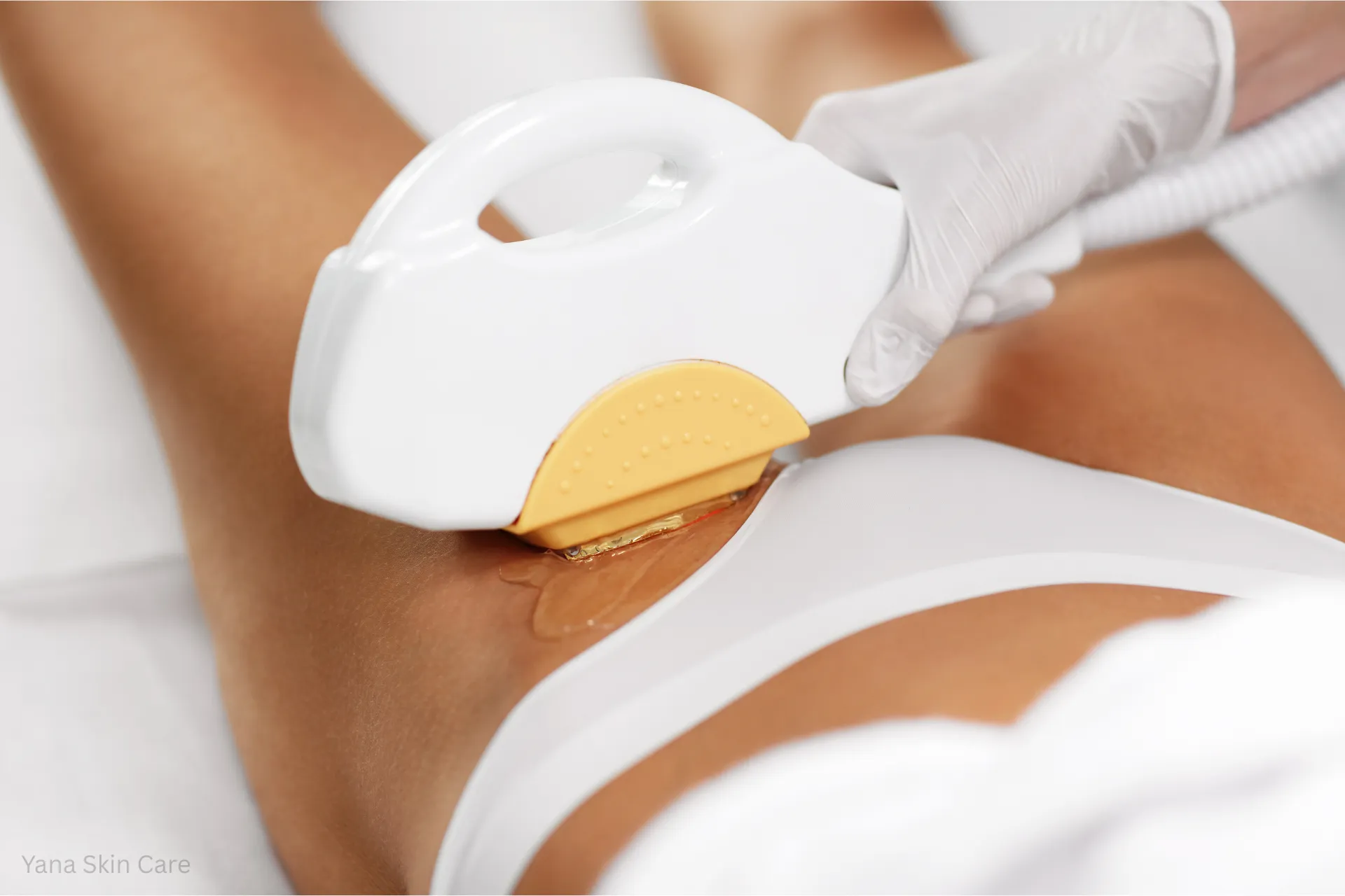 bikini vs brazilian laser hair removal