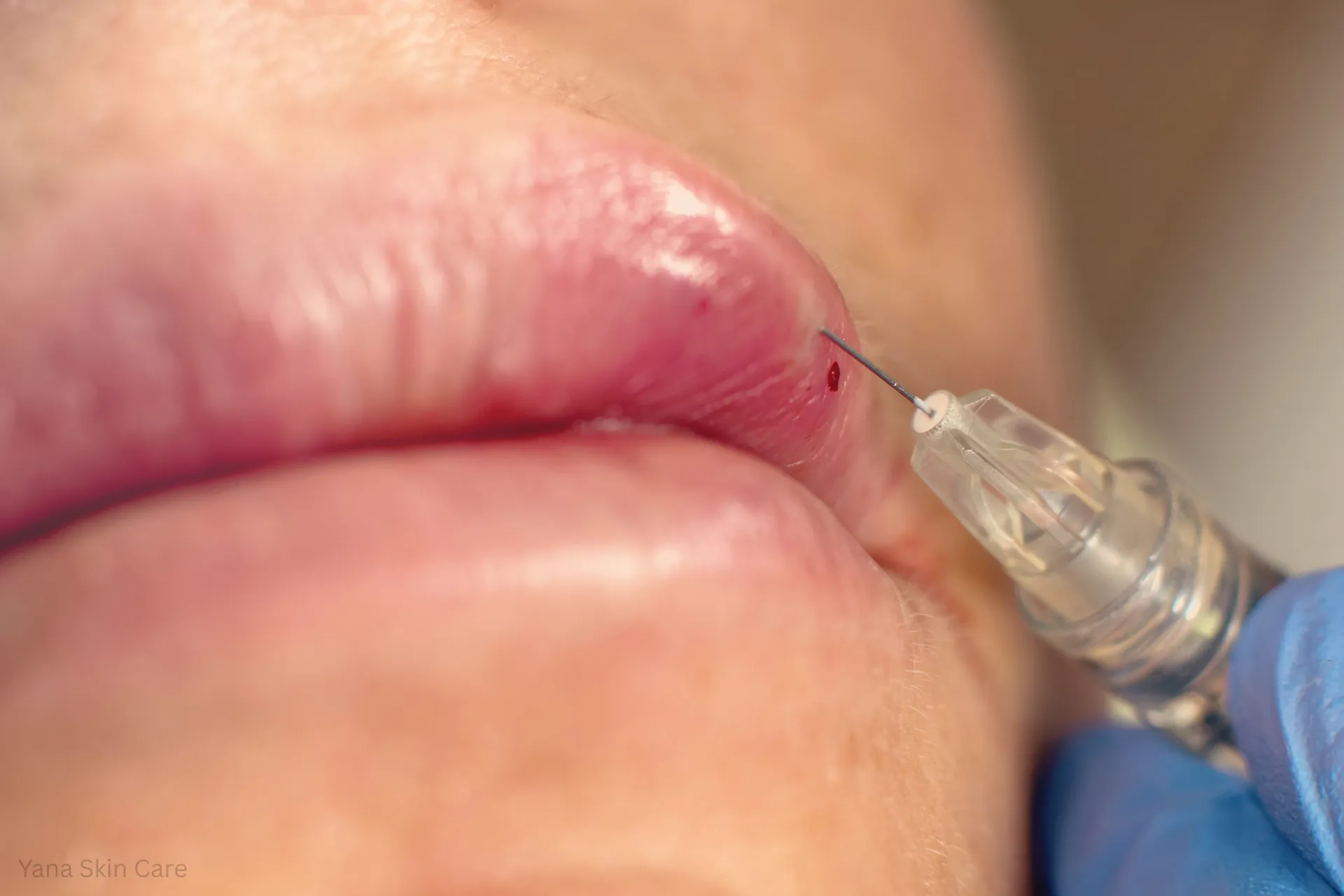 how long does lip filler last