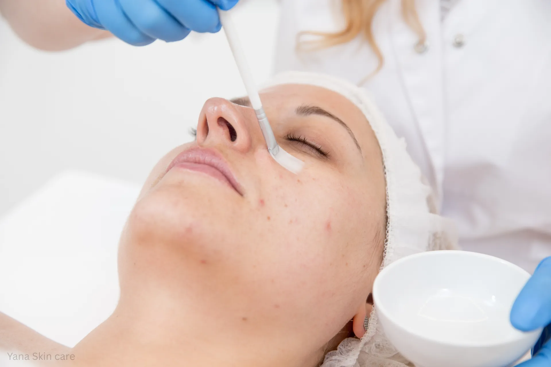 how much does a chemical peel cost
