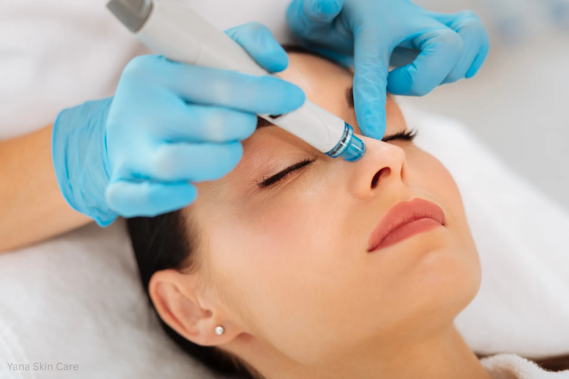 hydrafacial for acne