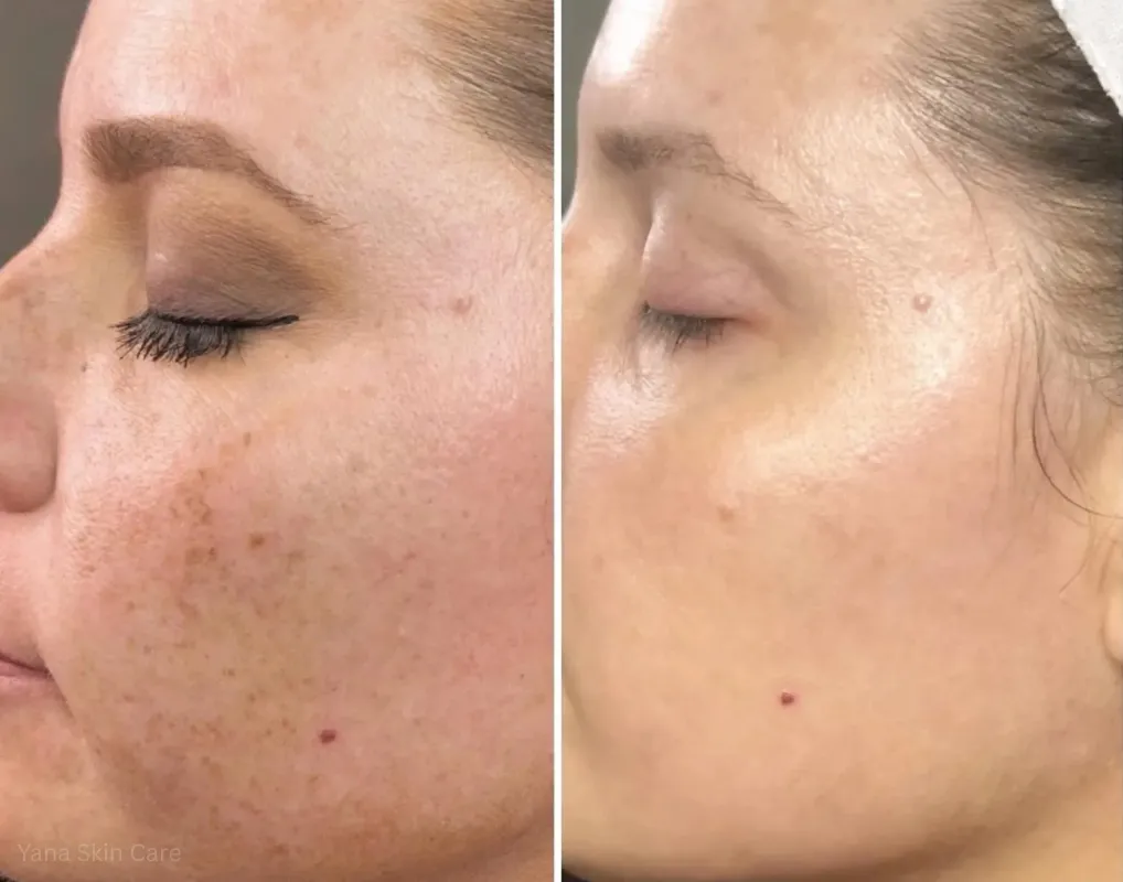 laser genesis before after
