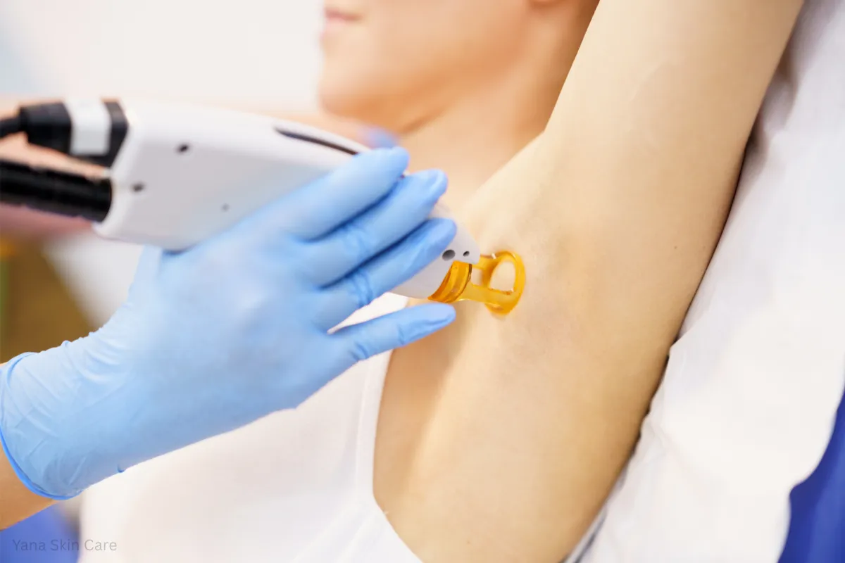 underarm laser hair removal sessions
